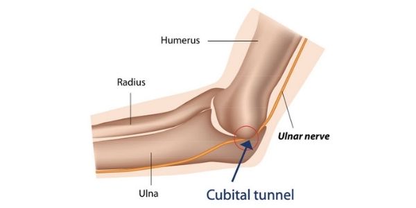 How to Address Cubital Tunnel – Practical Expert Advice - Trio  Rehabilitation & Wellness Solutions